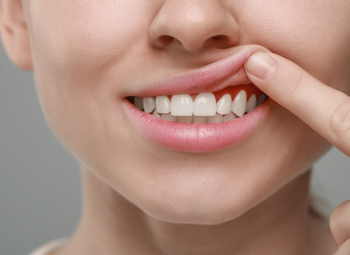 Procedure Image - The London Smile Clinic