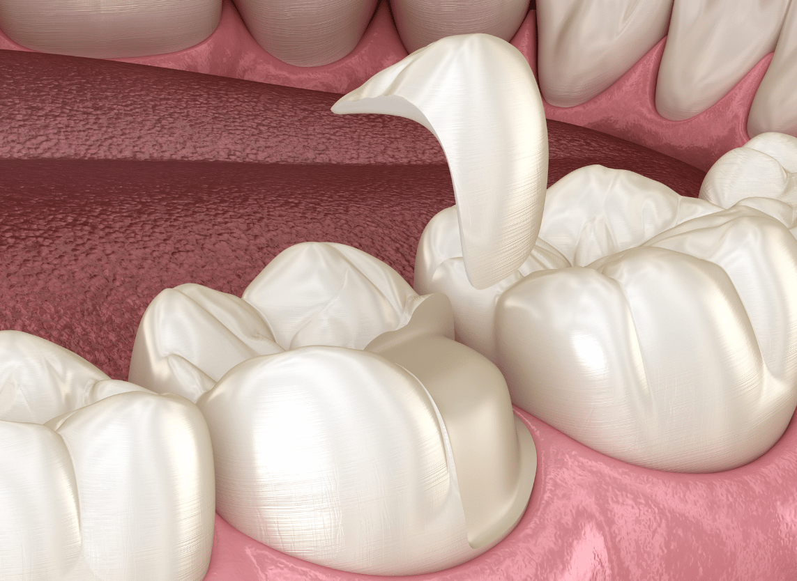 Procedure Image - The London Smile Clinic