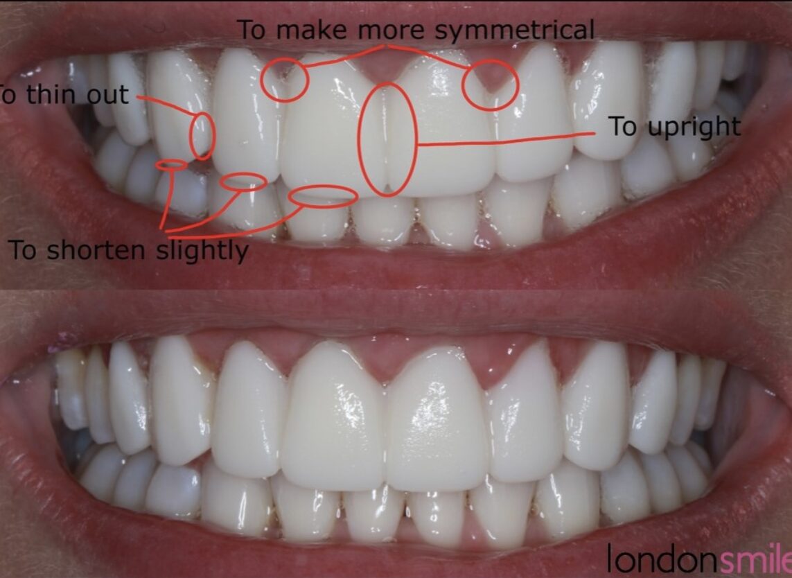 Procedure Image - The London Smile Clinic