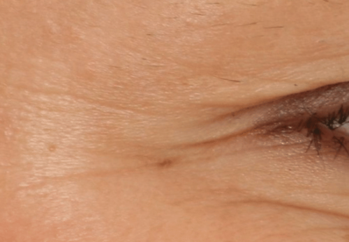 After Image - The London Smile Clinic