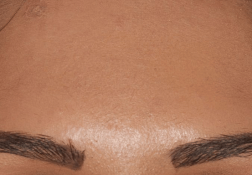 After Image - The London Smile Clinic