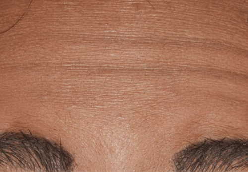 Before Image - The London Smile Clinic