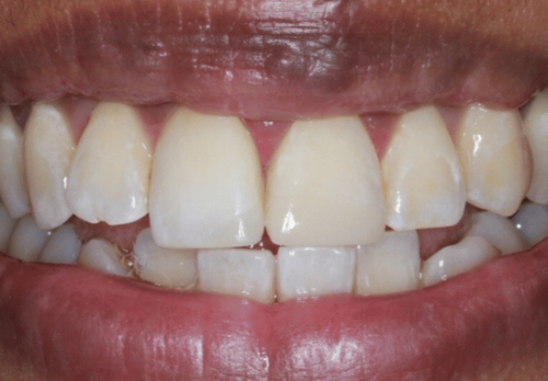 After Image - The London Smile Clinic