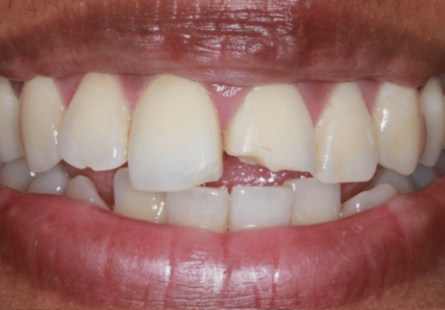Before Image - The London Smile Clinic