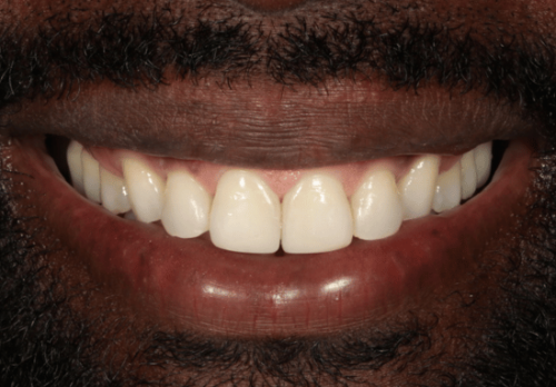 After Image - The London Smile Clinic