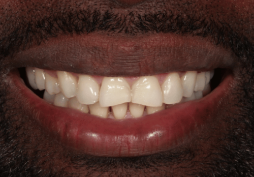 Before Image - The London Smile Clinic