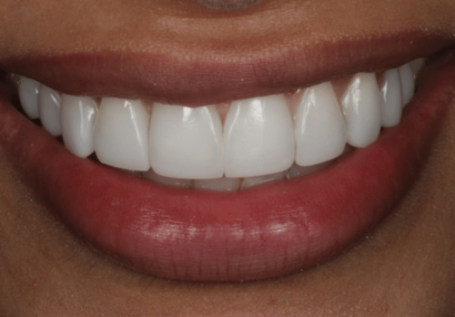 After Image - The London Smile Clinic