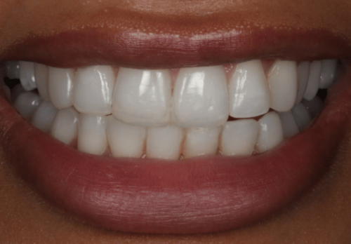 Before Image - The London Smile Clinic