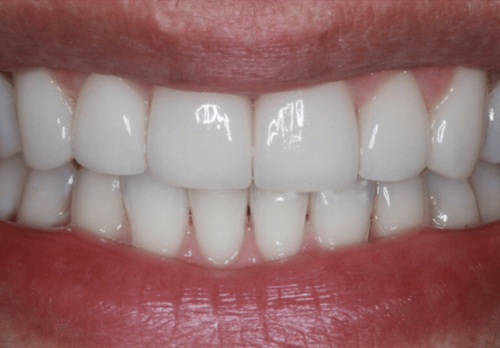 After Image - The London Smile Clinic