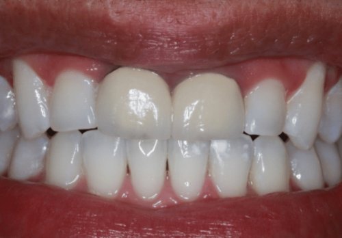Before Image - The London Smile Clinic