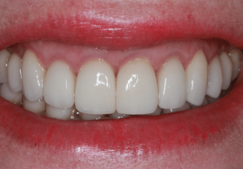 After Image - The London Smile Clinic