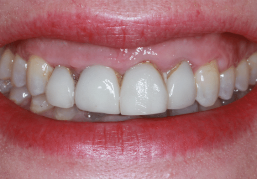 Before Image - The London Smile Clinic