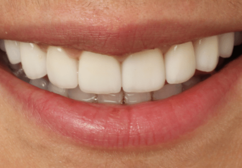 After Image - The London Smile Clinic