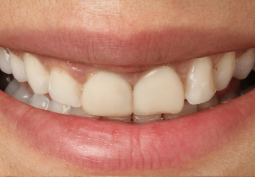 Before Image - The London Smile Clinic
