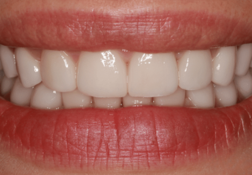 After Image - The London Smile Clinic