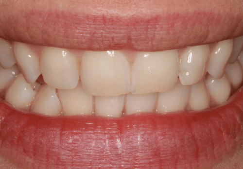 Before Image - The London Smile Clinic