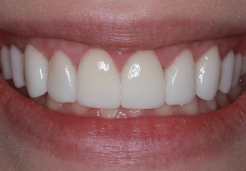 After Image - The London Smile Clinic