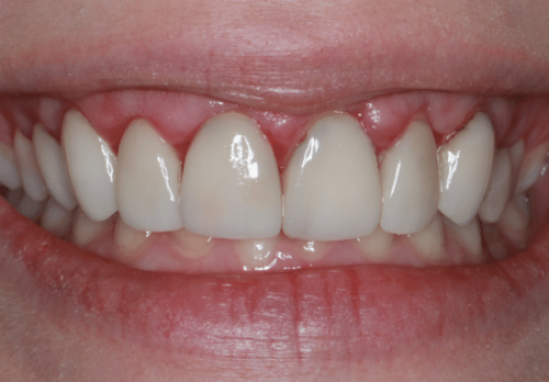 Before Image - The London Smile Clinic