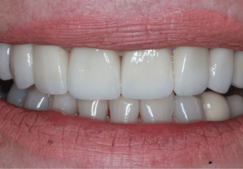 After Image - The London Smile Clinic