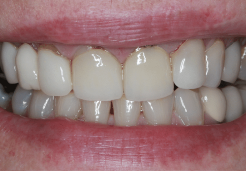 Before Image - The London Smile Clinic