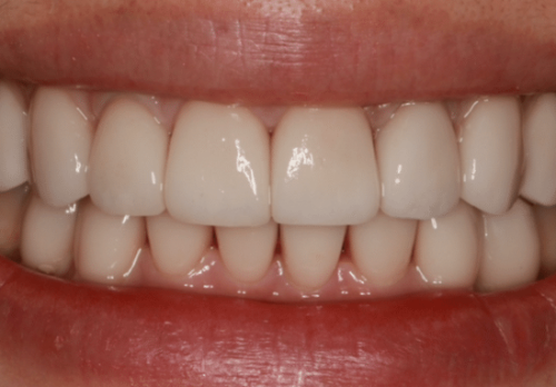After Image - The London Smile Clinic