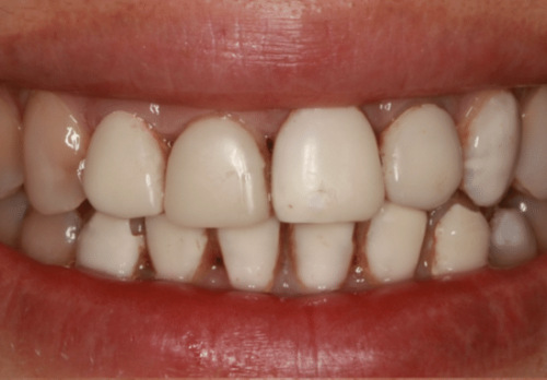 Before Image - The London Smile Clinic