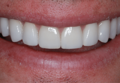 After Image - The London Smile Clinic