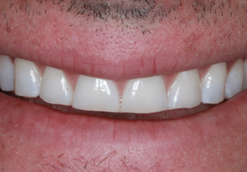 Before Image - The London Smile Clinic