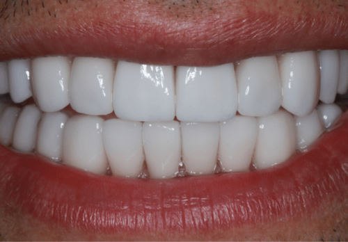 After Image - The London Smile Clinic