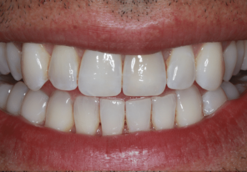 Before Image - The London Smile Clinic