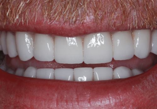 After Image - The London Smile Clinic