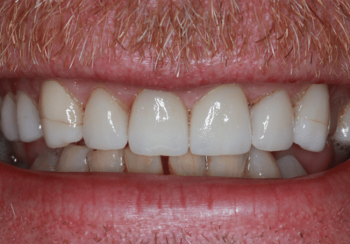 Before Image - The London Smile Clinic