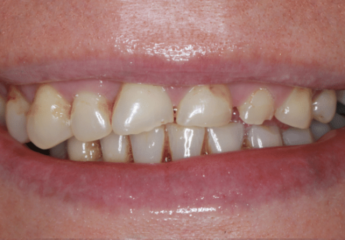 Before Image - The London Smile Clinic
