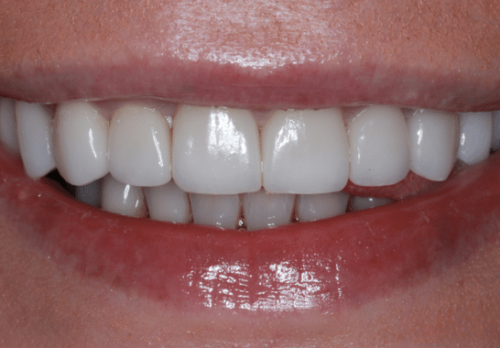After Image - The London Smile Clinic