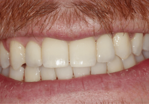 After Image - The London Smile Clinic