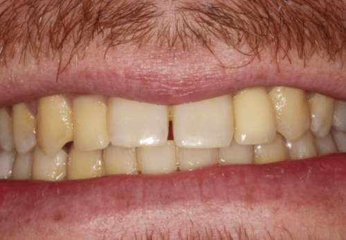 Before Image - The London Smile Clinic