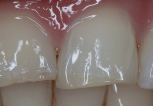 After Image - The London Smile Clinic