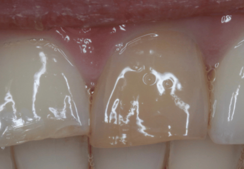 Before Image - The London Smile Clinic