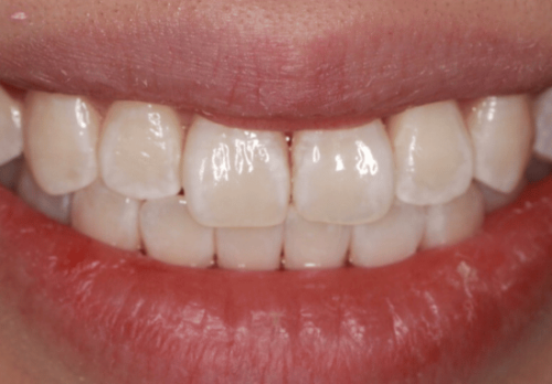 After Image - The London Smile Clinic