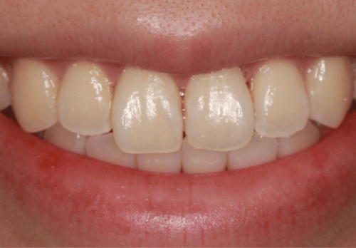 Before Image - The London Smile Clinic