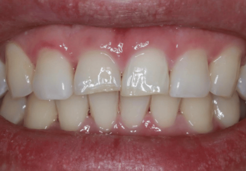 After Image - The London Smile Clinic