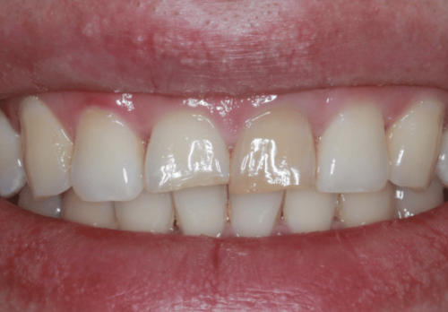 Before Image - The London Smile Clinic