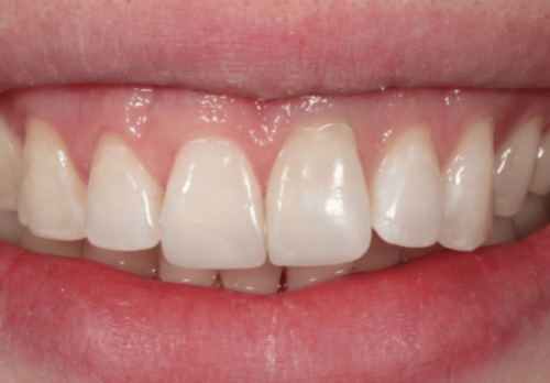 After Image - The London Smile Clinic
