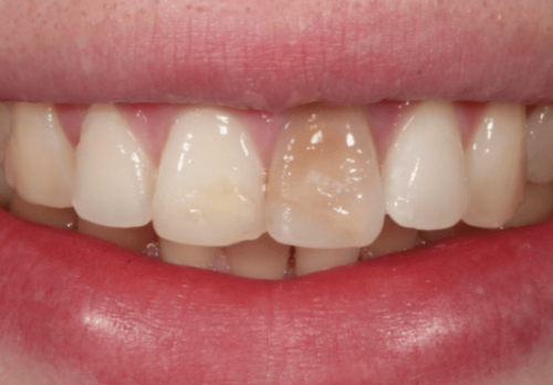 Before Image - The London Smile Clinic