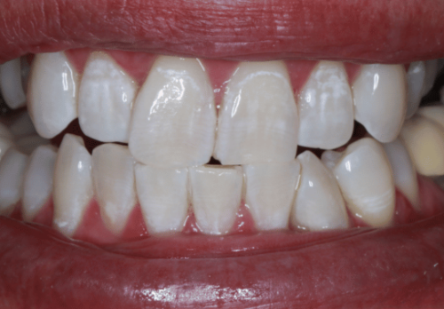 After Image - The London Smile Clinic