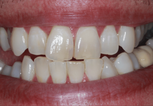 Before Image - The London Smile Clinic